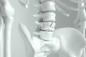 Osteoporosis
