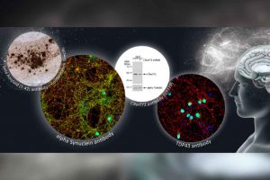 Los científicos han logrado un gran avance que podría marcar la diferencia para ayudar a tratar y, algún día, curar a los pacientes con enfermedades neurodegenerativas.